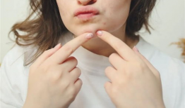 挤痘痘视频,专业视频教你正确操作