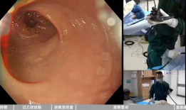 肠镜视频全过程,直观呈现肠道健康状态